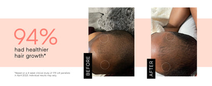 Electric High-Frequency Therapy Device – Wireless High Wave Electrotherapy Rod (1 Set)