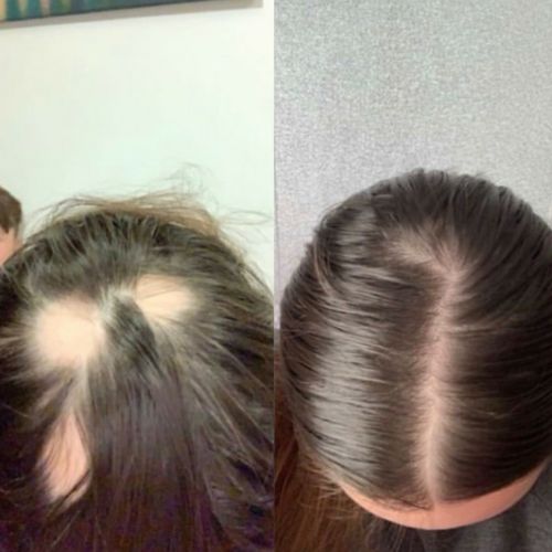 Bio Roller Microneedle Portable for Hair Growth – 0.5mm