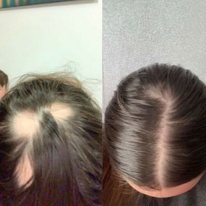 Bio Roller Microneedle Portable for Hair Growth – 0.5mm