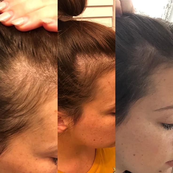 Rosemary & Castor Hair Growth Oil & Anti-Loss Treatment (118ml) + Scalp Massage Brush - Ophira Cosmetics™