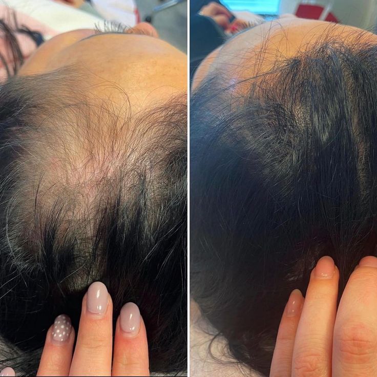 Rosemary & Castor Hair Growth Oil & Anti-Loss Treatment (118ml) + Scalp Massage Brush - Ophira Cosmetics™