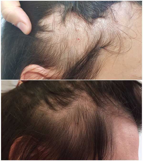 Rosemary & Castor Hair Growth Oil & Anti-Loss Treatment (118ml) + Scalp Massage Brush - Ophira Cosmetics™